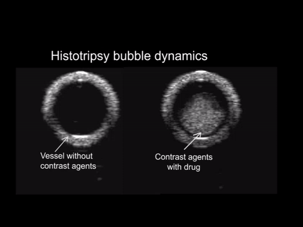 Histotripsy bubble dynamics without (left) and with (right) extrinsic nuclei